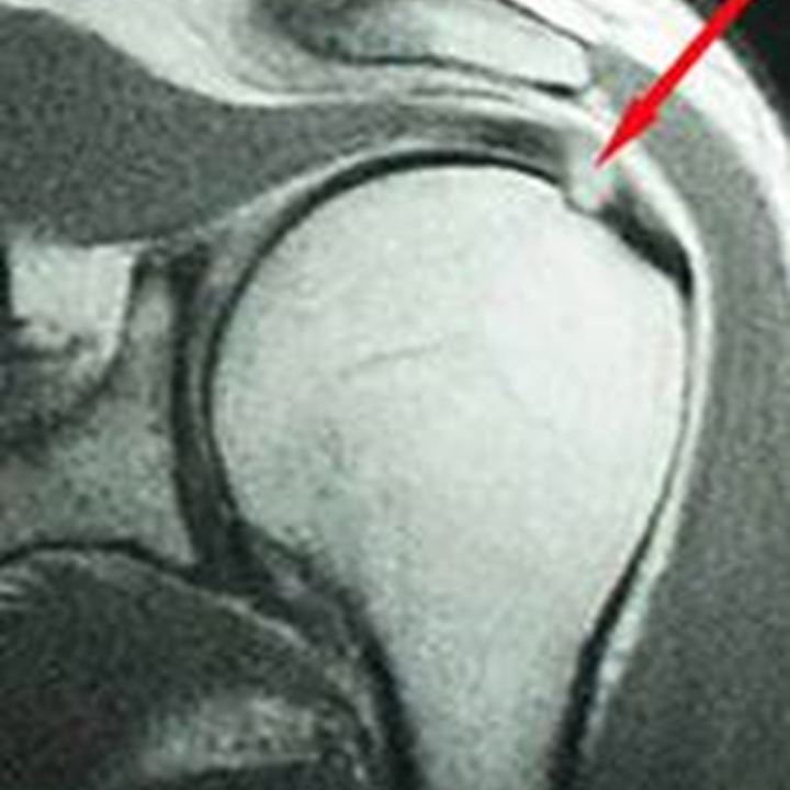 Kernspintomographie (MRI) der Schulter: mit Sehnenriss